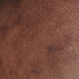 hyperpigmentation skin texture