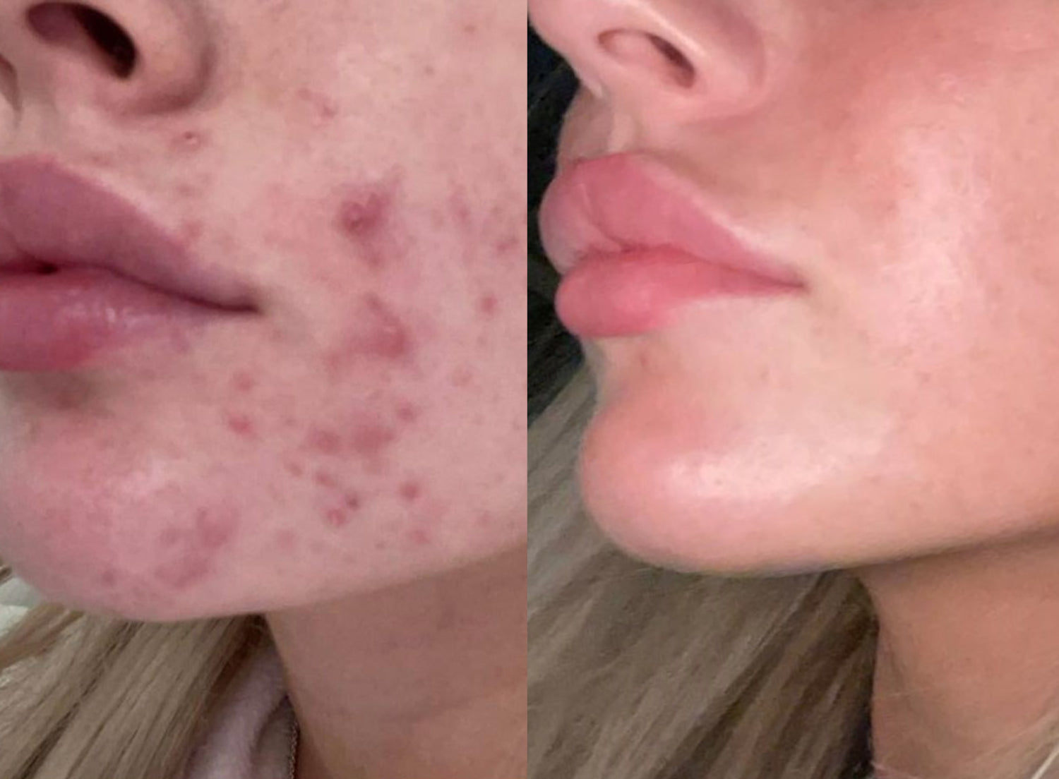 Salicylic acid before and after