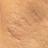 acne scarring skin texture