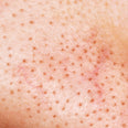 Blackheads skin texture