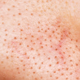 Blackheads skin texture